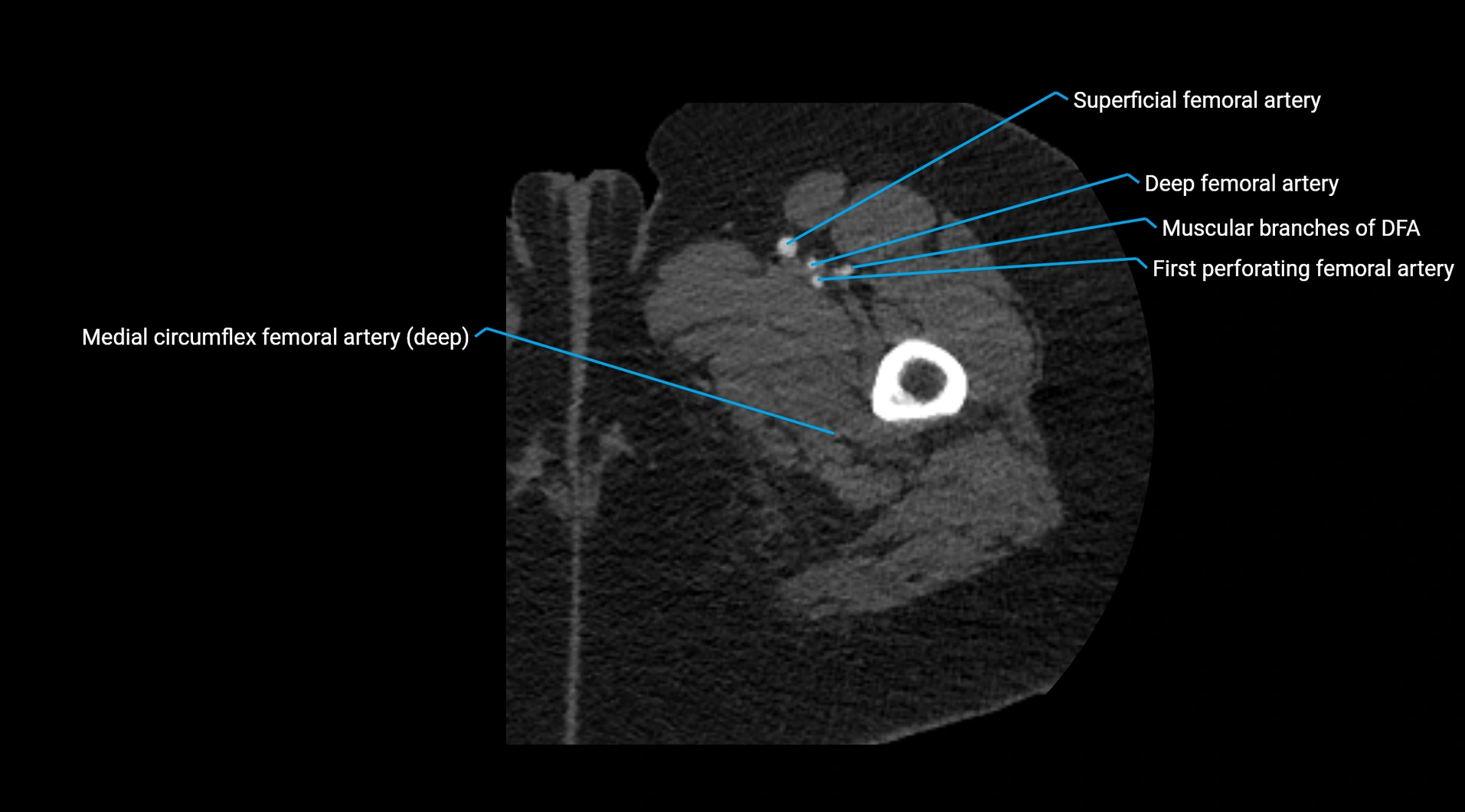 CTA lower limb cross sectional anatomy labelled image _80.webp